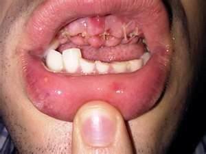 missingteeth3.jpg missingteeth3.jpg