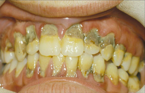 45_facialLingualCaries.jpg