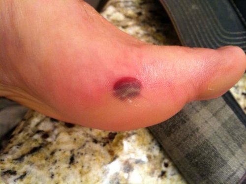 utah blister.jpg