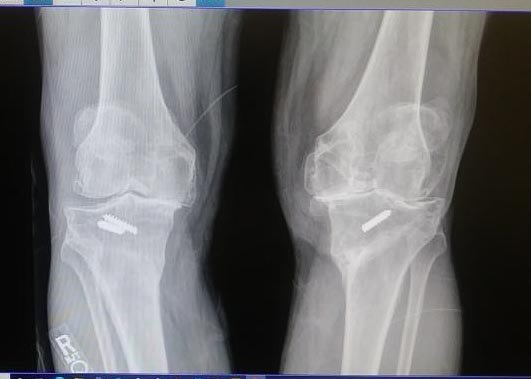 Ken's  knee replacment x ray December 2021 aA (2).JPG