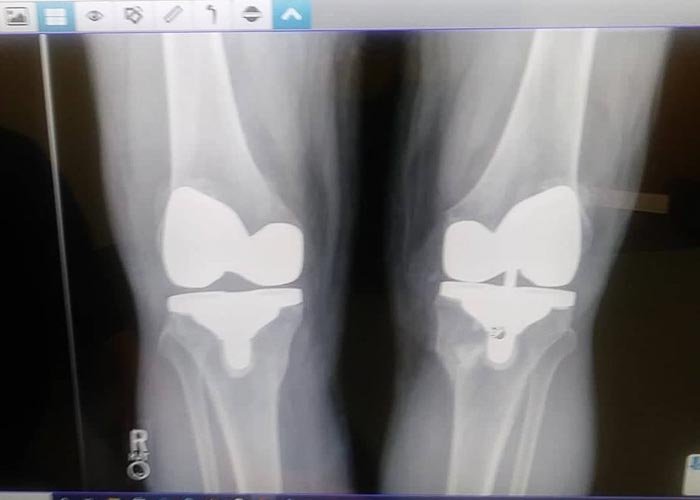 Ken's  knee replacment x ray April 2022 a-13 A.JPG