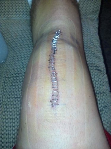 Randy's New Knee.jpg