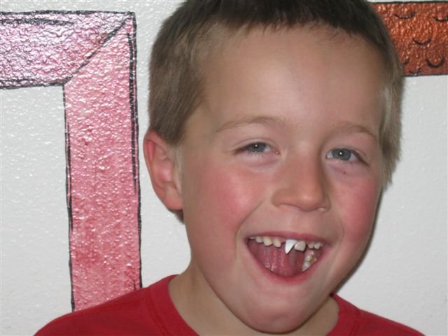 Bode tooth.jpg Bode tooth.jpg
